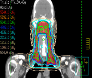 Dieses Bild zeigt Nasopharynx-Ca mit VMAT-Technik coronale Sicht.