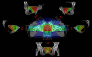 Prinzip der IMRT-Bestrahlung