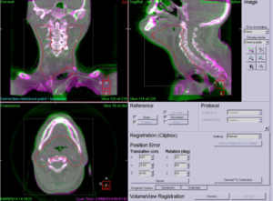Dieses Bild zeigt die Darstellung der Überlagerung vom Planungs-CT und am Gerät angefertigten ConeBeam-CT.
