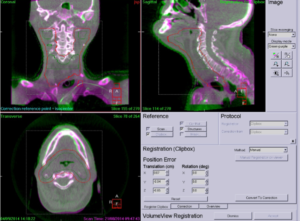 Darstellung der Überlagerung vom Planungs-CT und am Gerät angefertigten ConeBeam-CT.